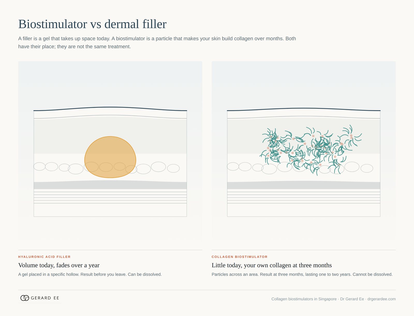 Collagen biostimulator vs dermal filler: a hyaluronic acid gel gives volume today; a biostimulator makes the skin build its own collagen over months