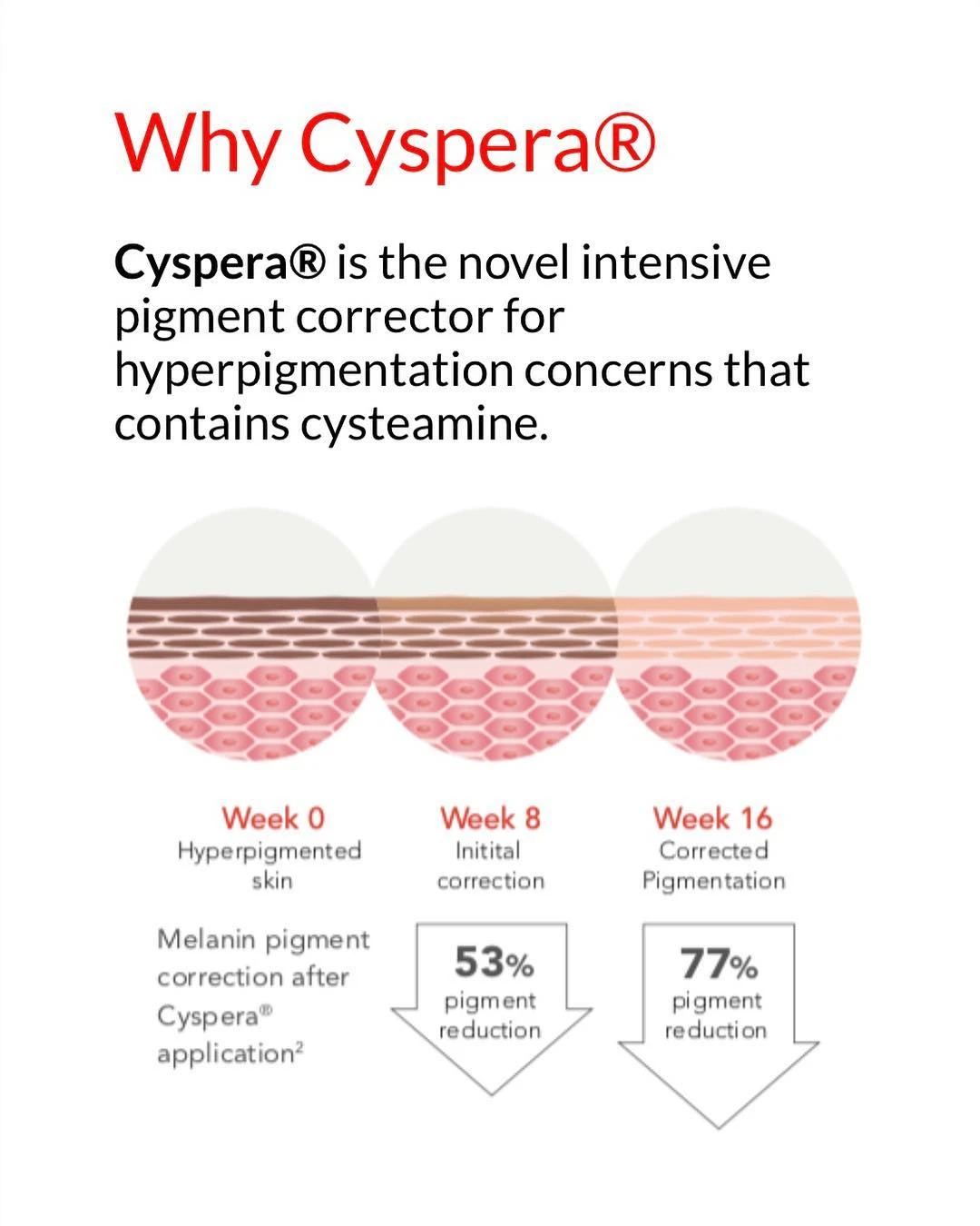 Pigment reduction in melasma after Cyspera cysteamine cream