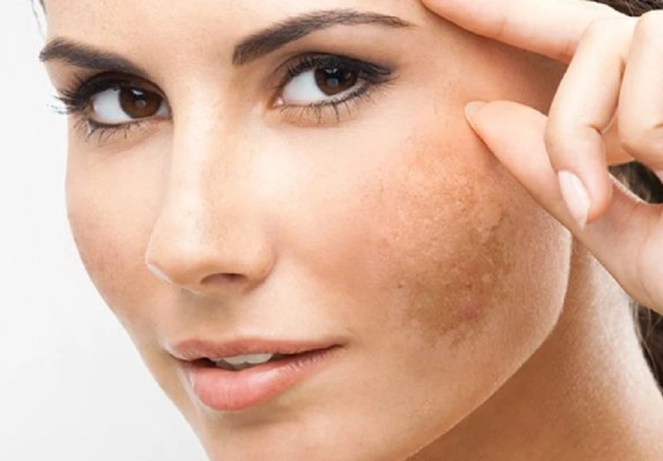 Melasma pigmentation on the cheeks treated with Cyspera in Singapore