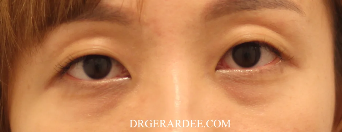 Dark eye circle treatments reviewed