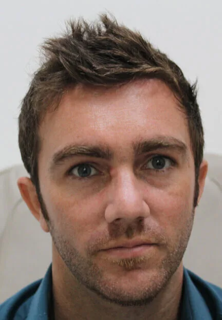 Male patient with dark eye circles and shadowing beneath both eyes