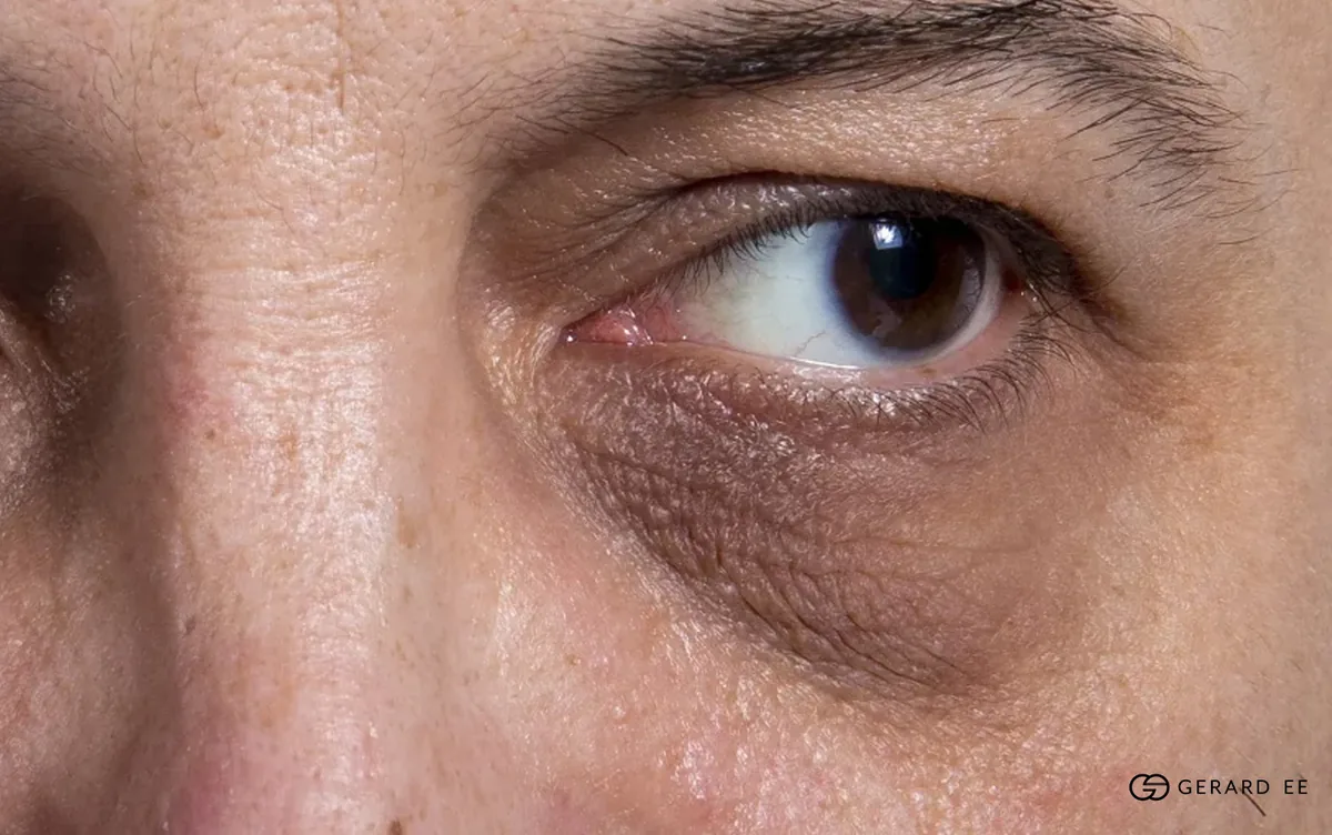 Dark eye circles from pigment and vessels, not an eye bag