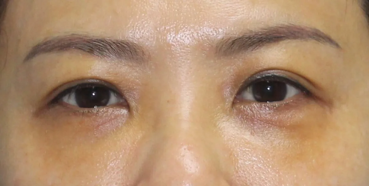 Dark eye circles with under-eye hollowing and pigmentation