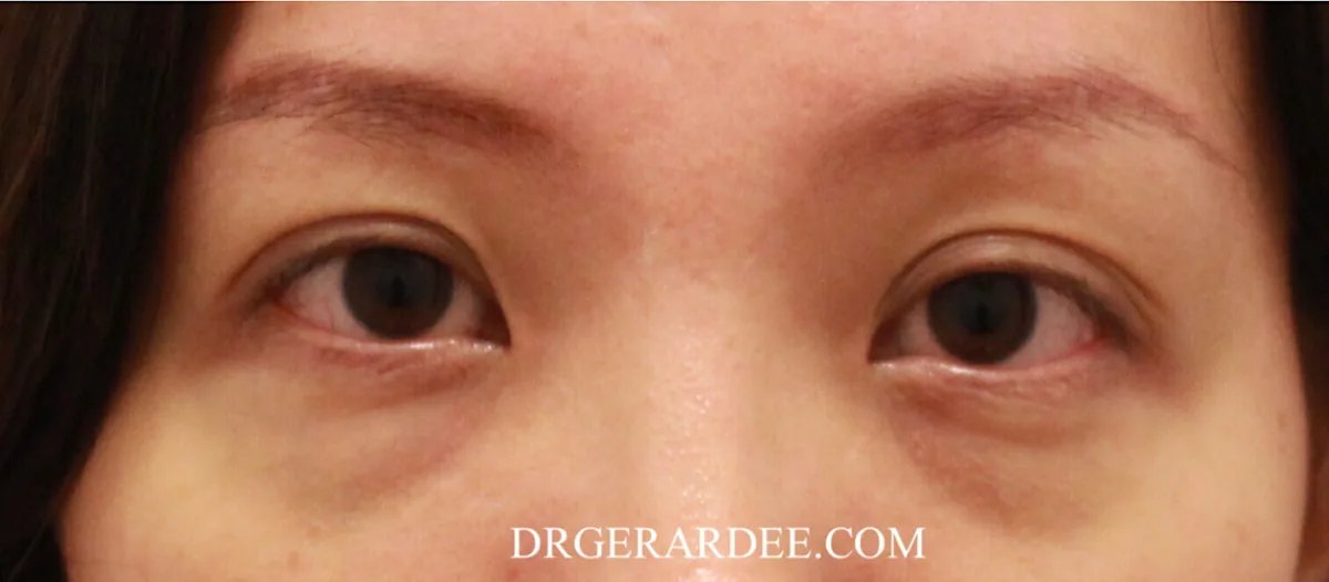 Dark eye circles with tear trough hollowing below both eyes