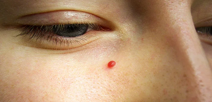 Haemangiomas: What is the difference between a Port Wine Stain and a haemangioma?