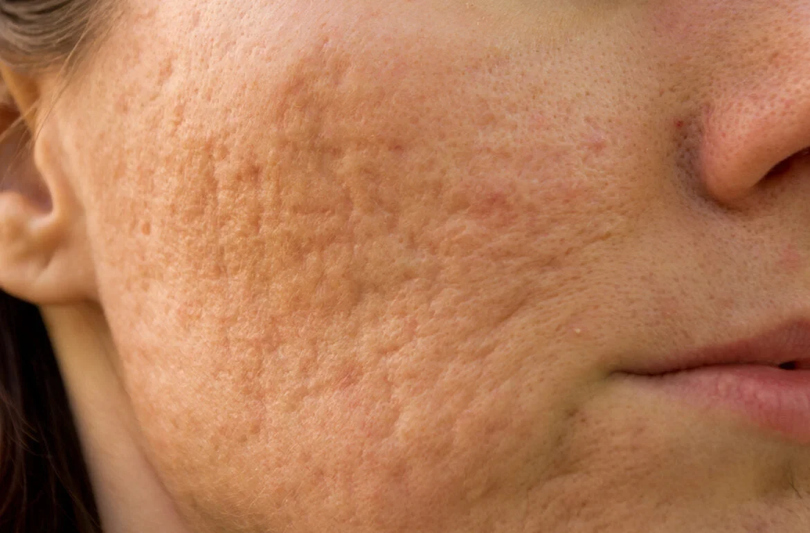 Acne scars that do not fade on their own