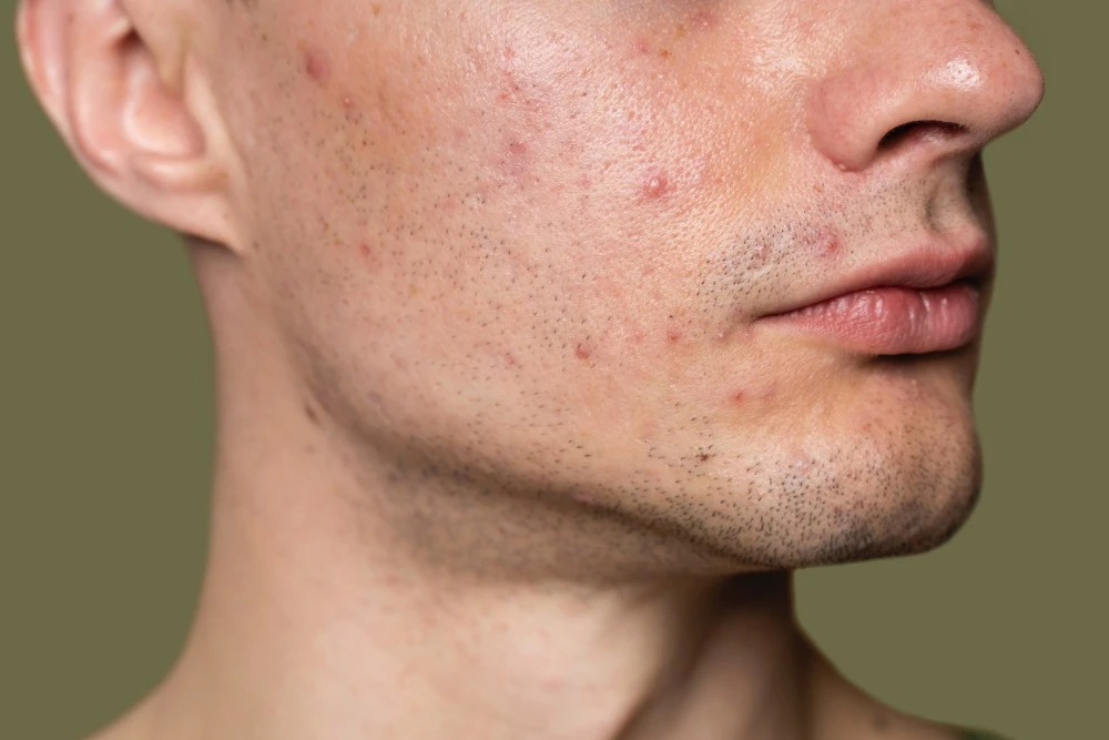 Vitamin C serum used on acne-prone skin