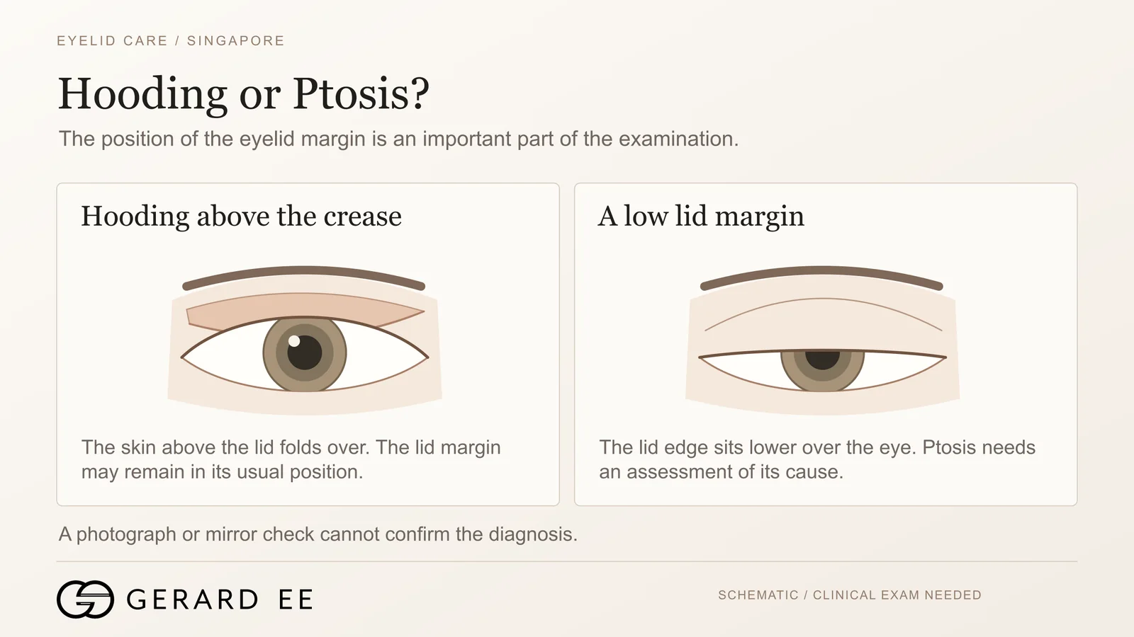 Droopy eyelid hooding above the crease compared with ptosis where the lid margin sits low