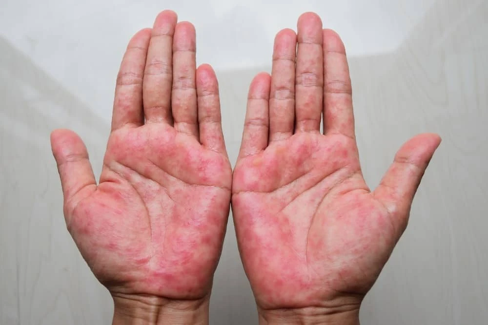 Atopic dermatitis on the skin treated with creams and UVB