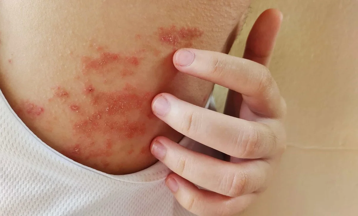 Atopic dermatitis, the most common type of eczema seen in eczema treatment in Singapore