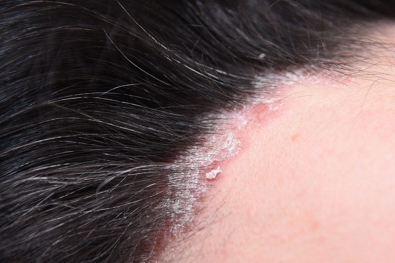 Seborrhoeic dermatitis on the face, a type of eczema that needs different eczema treatment in Singapore