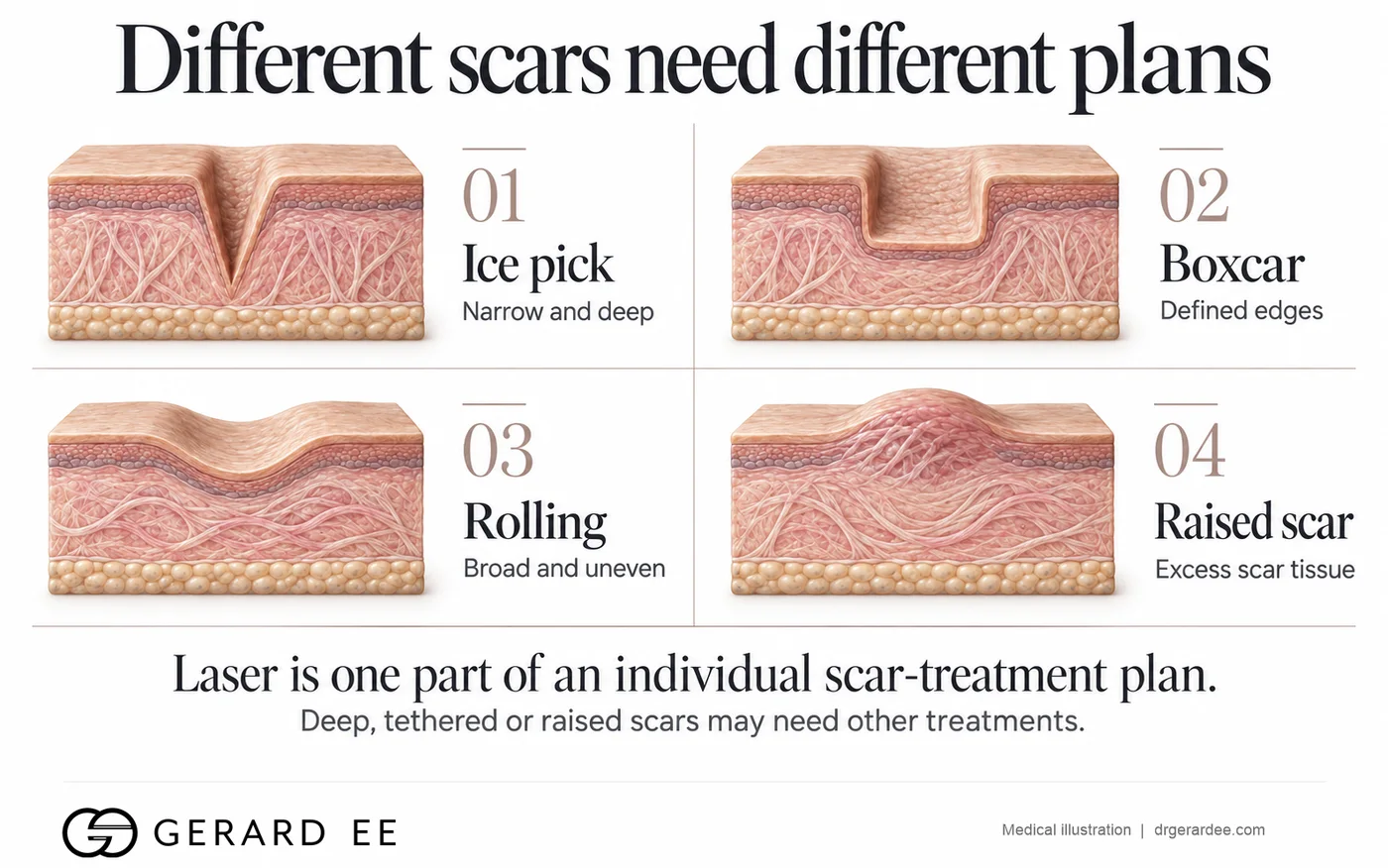 Edge fractional CO2 laser, a considered approach to acne scars and skin texture