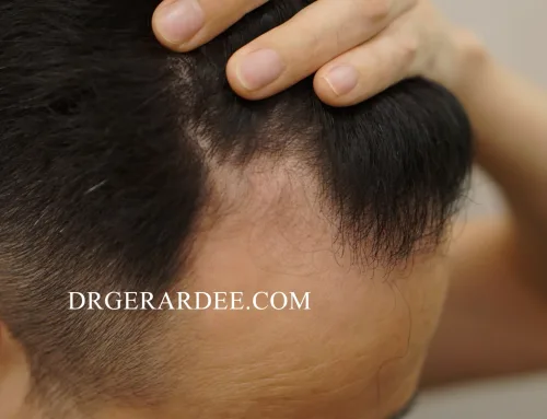 How Effective Are Hair Transplants?