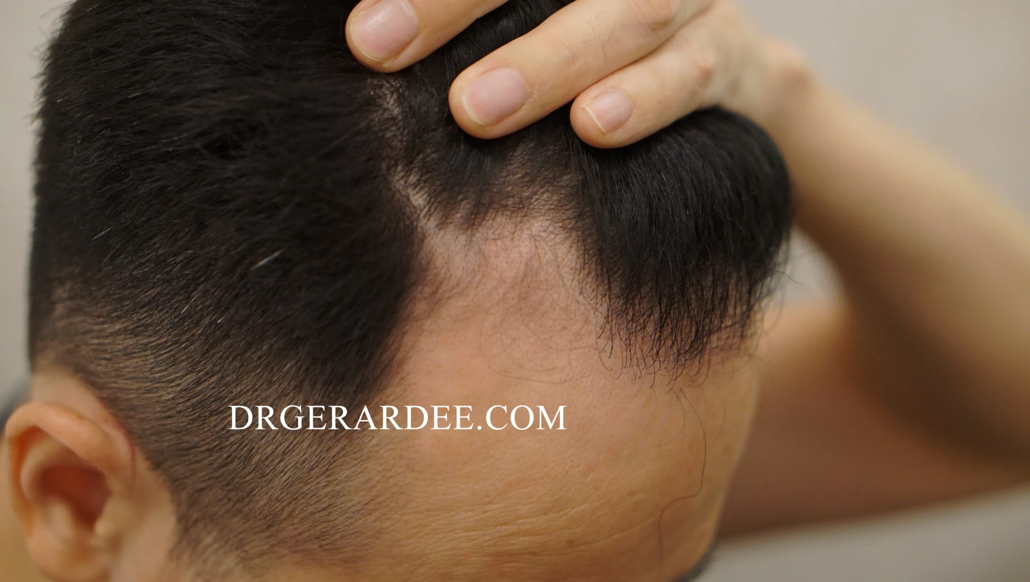 Hair transplant consultation and scalp assessment in Singapore