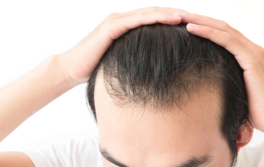 FUE hair transplant procedure in Singapore