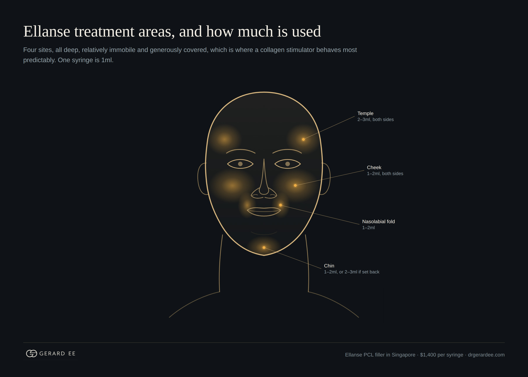Ellanse filler treatment areas in Singapore: temple 2 to 3ml, cheek 1 to 2ml, nasolabial fold 1 to 2ml, chin 1 to 2ml
