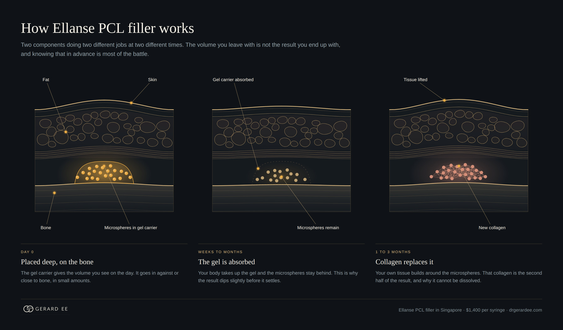 How Ellanse PCL filler works: microspheres in gel carrier placed on bone, gel absorbed, new collagen formed