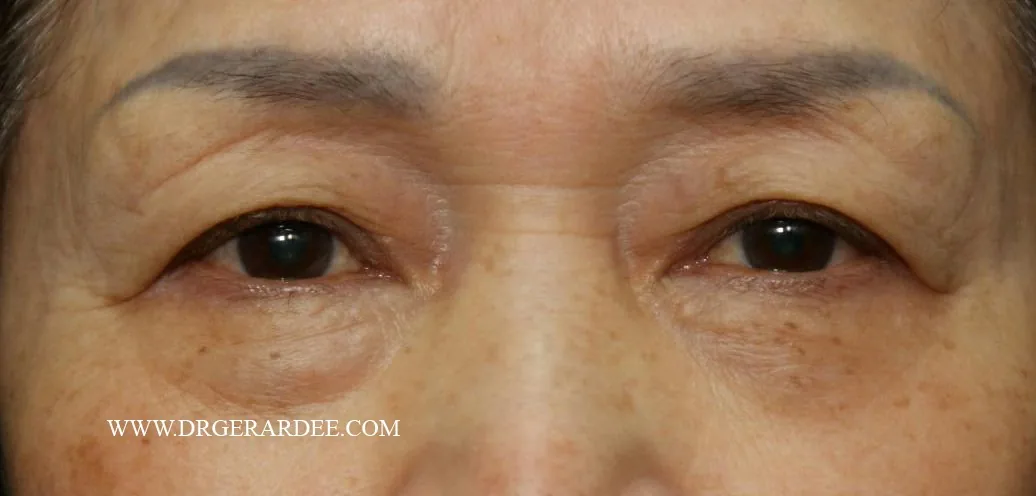 eye bags needing scarless eye bag removal surgery Lower eyelid eye bags from orbital fat prolapse, the type that needs scarless eye bag removal surgery