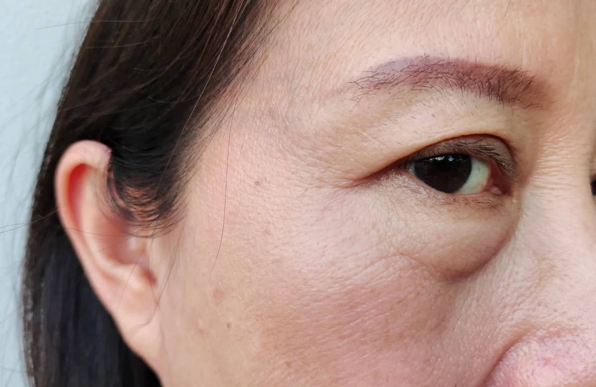 eye bags that eye cream cannot remove Eye bags from fat protrusion that eye cream, sleep or cold compresses cannot remove