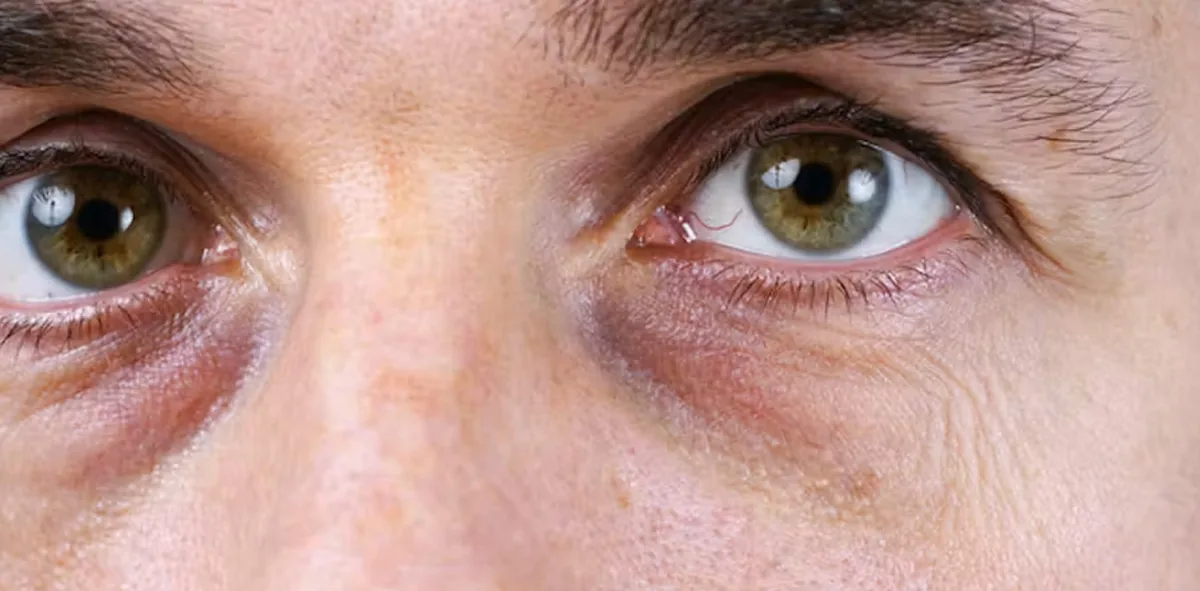 Eye bags vs tear troughs: a man's lower eyelids showing fat bulge and shadow