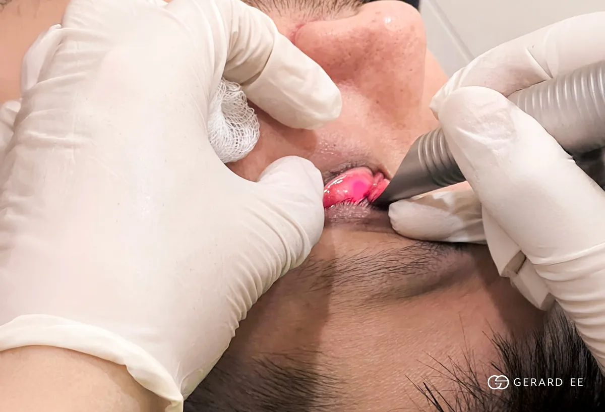 Fotona laser handpiece used inside the mouth; laser protocols do not remove eye bag fat