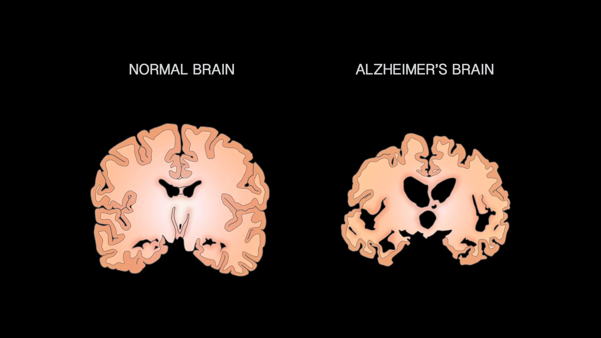 Alzheimer’s disease Alzheimer's disease and GLP-1 research