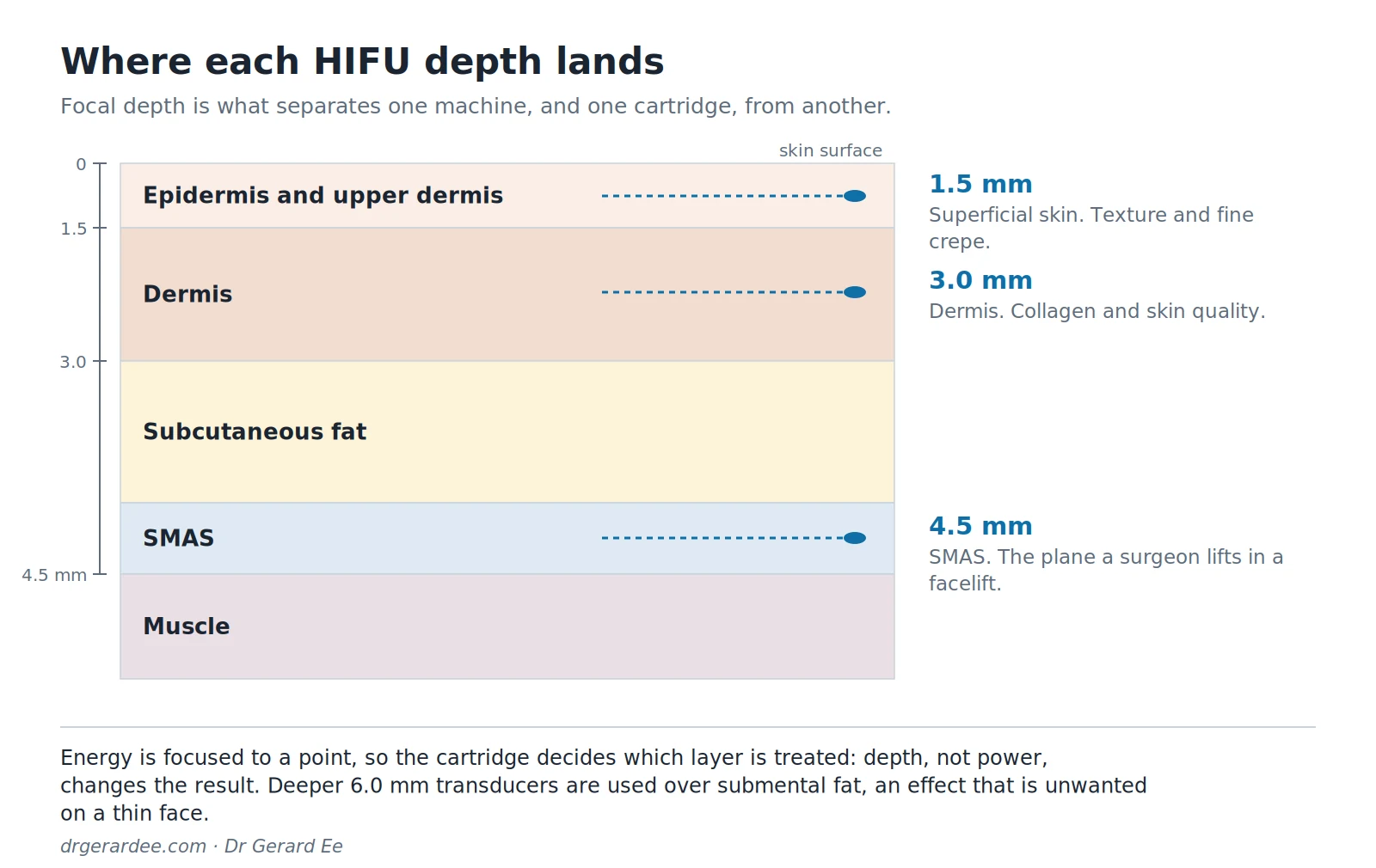 Diagram of HIFU treatment depths at 1.5, 3.0 and 4.5 mm against the skin, dermis and SMAS layers