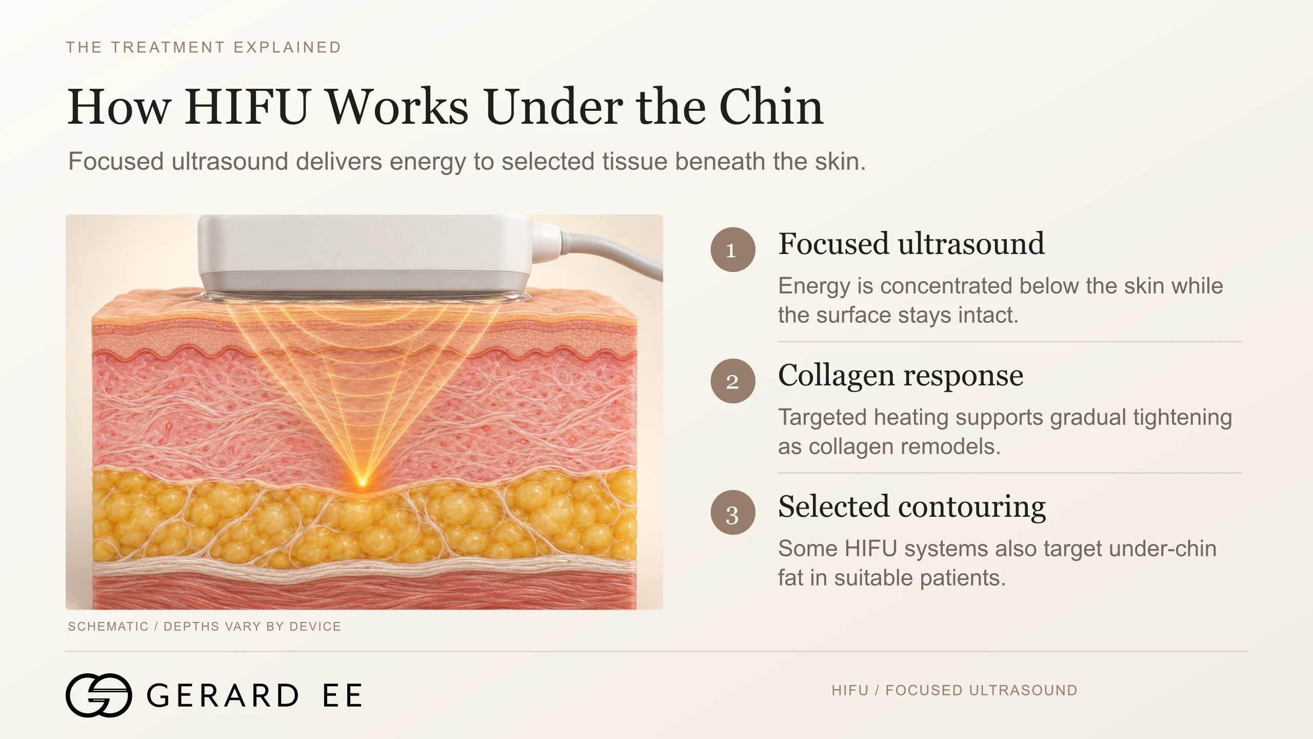 How HIFU works under the chin, focused ultrasound, collagen response and under-chin fat contouring