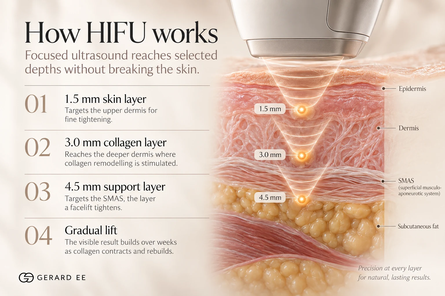 How HIFU works in Singapore, focused ultrasound heating the 1.5, 3.0 and 4.5 mm skin depths