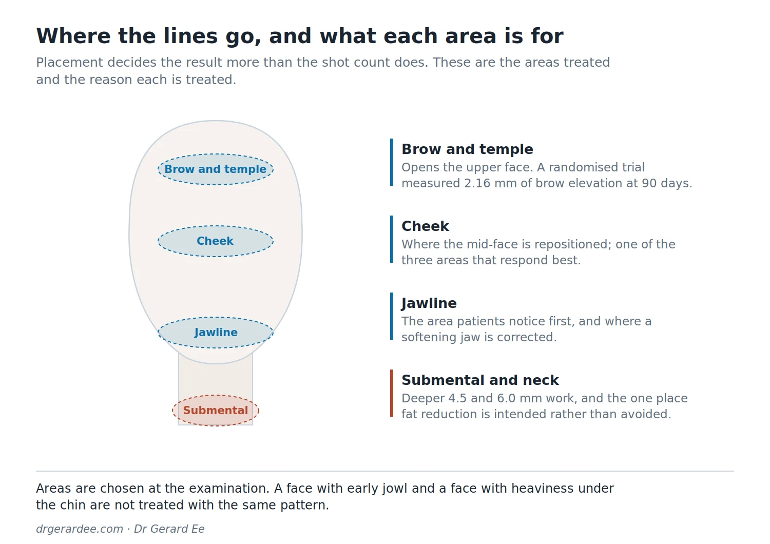 Diagram of the facial areas treated with HIFU in Singapore, including jawline, cheek, perioral and submental zones
