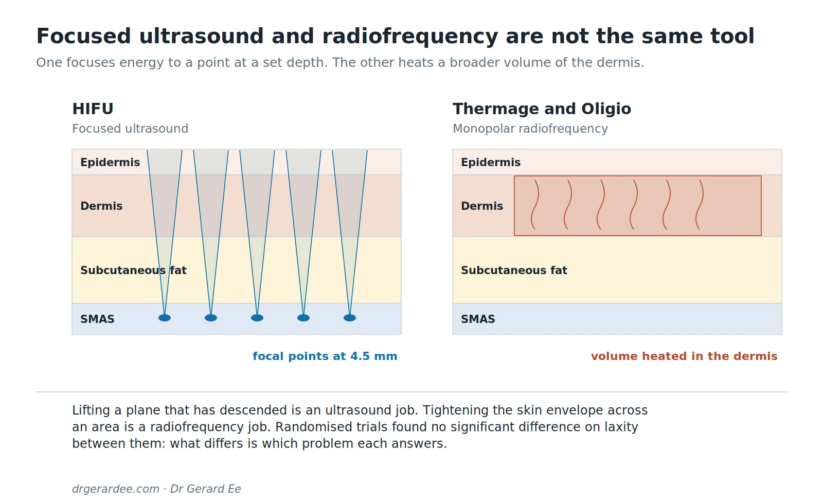 Diagram comparing focused ultrasound thermal points with the broader volumetric heating of monopolar radiofrequency