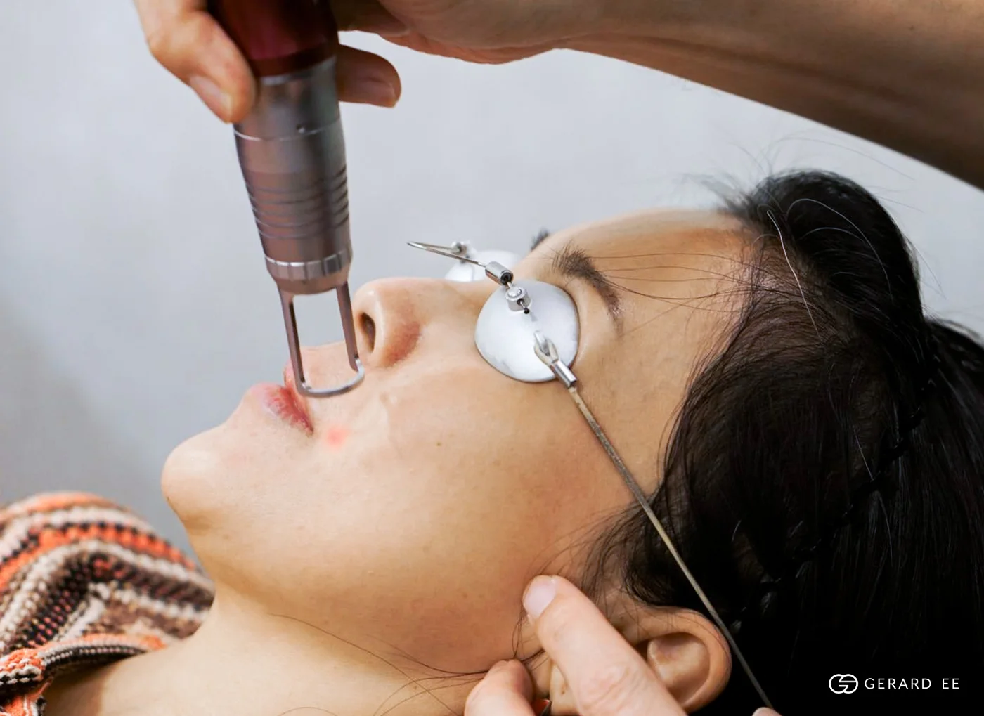 Q switch laser: Treating the marks hormonal acne leaves