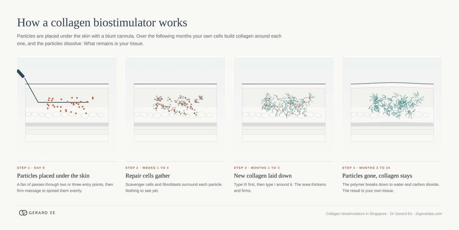 How a collagen biostimulator works: particles placed under the skin, repair cells gather, new collagen is laid down, particles dissolve and collagen remains