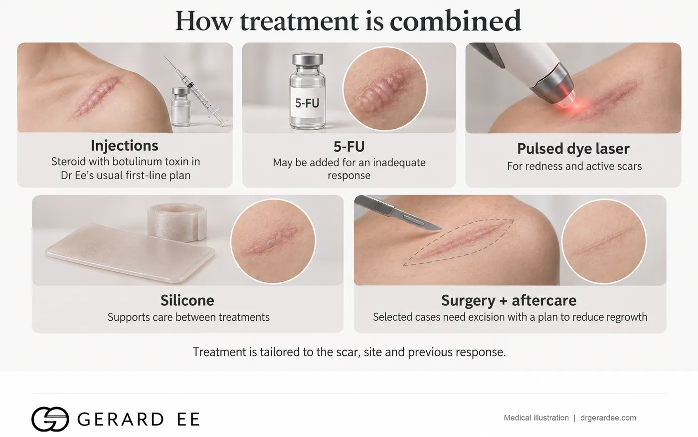 How keloid treatment is combined