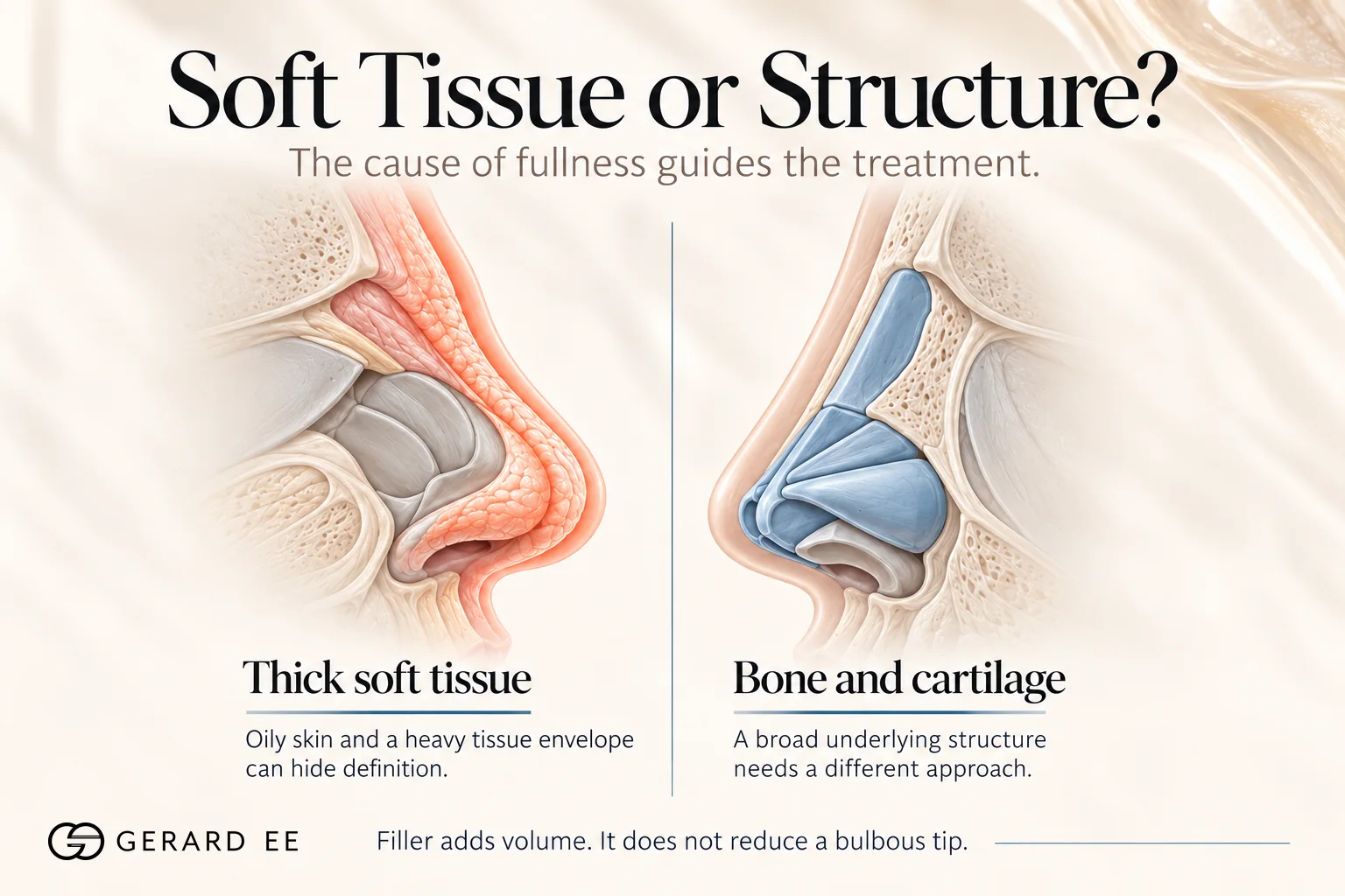 Bulbous nose caused by thick soft tissue compared with a broad bone and cartilage structure