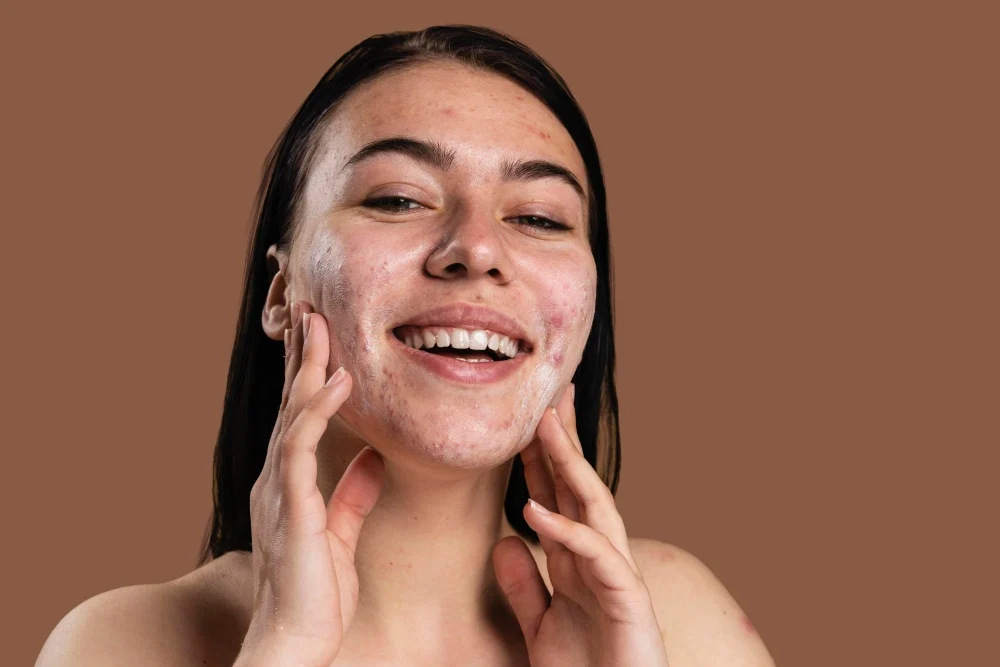 Pimple scar treatment in Singapore: the procedures used once a pimple has scarred