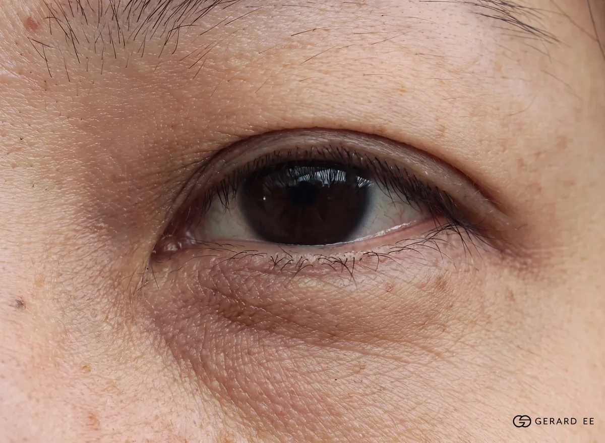Is non-surgical eye bag removal permanent: close-up of a lower eyelid fat pad