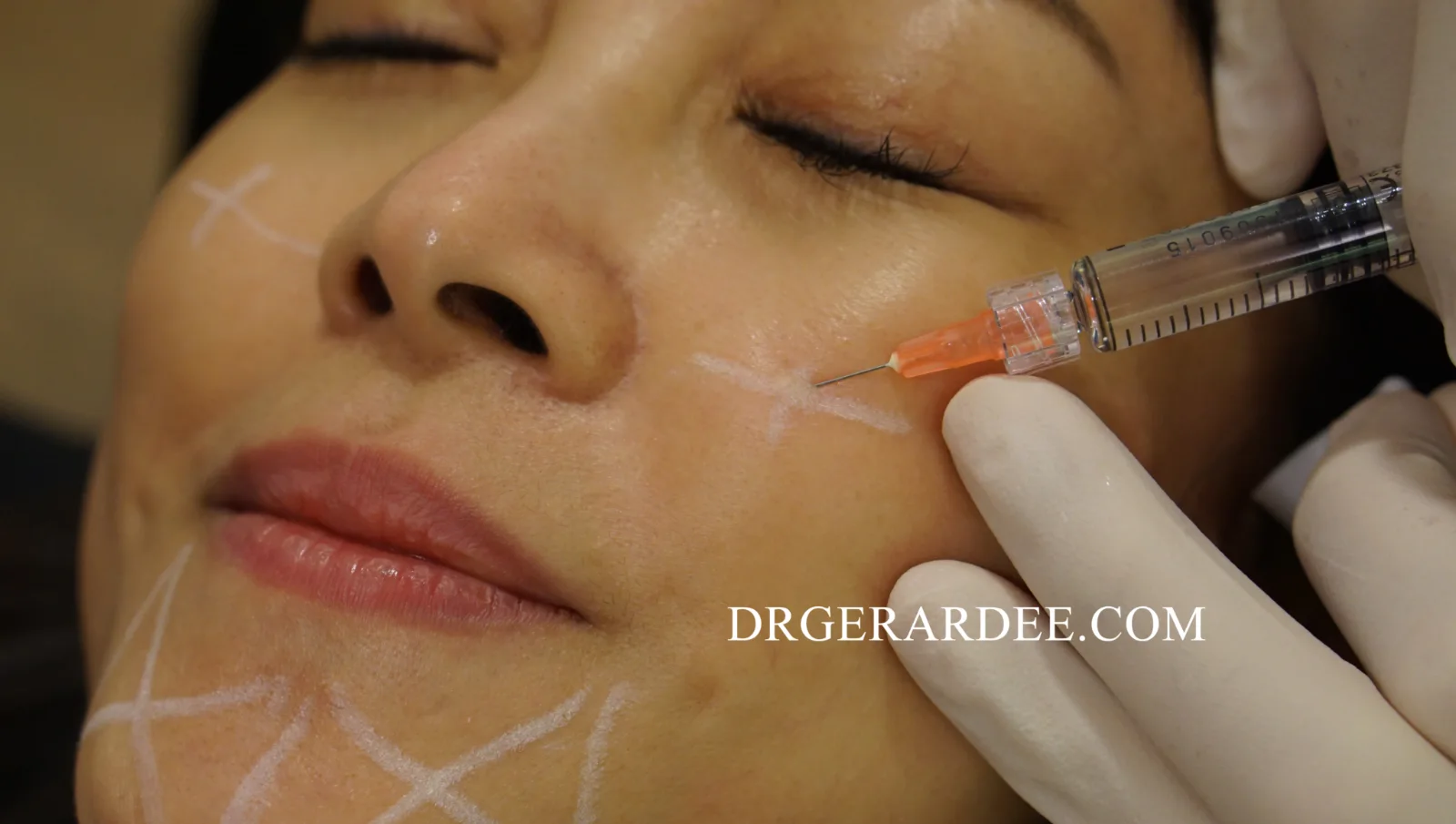 Profhilo injection, is Profhilo safe and effective