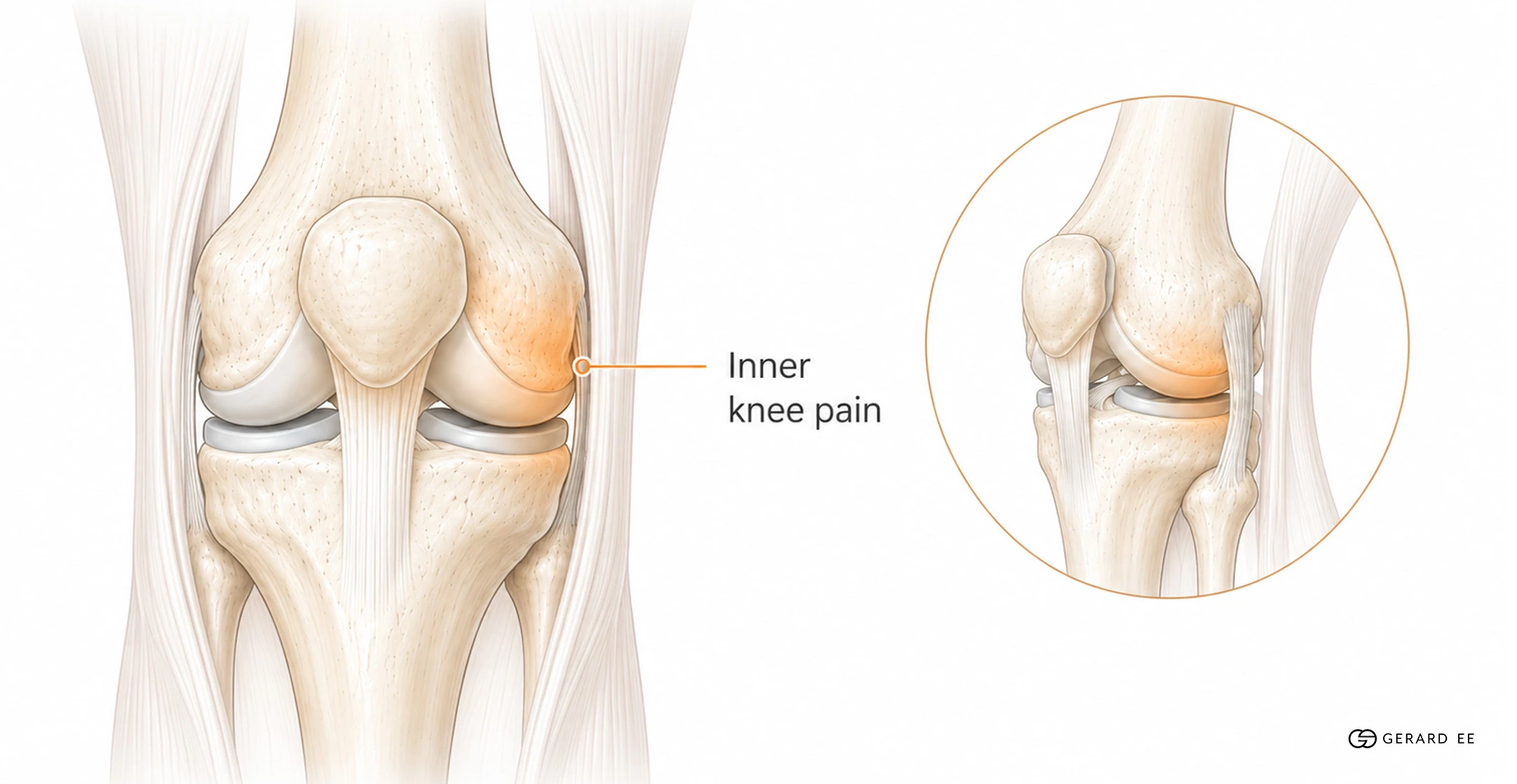 medial knee pain Medial knee pain on the inner knee