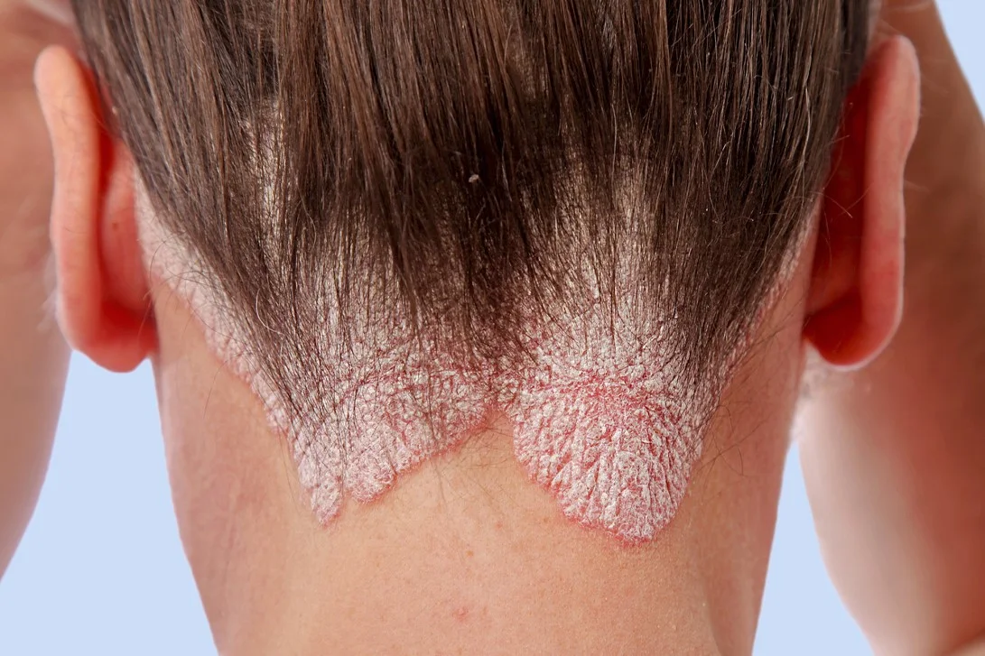 Psoriasis: LDM and its benefits in the treatment of Eczema – Local dynamic Micro Ultrasound