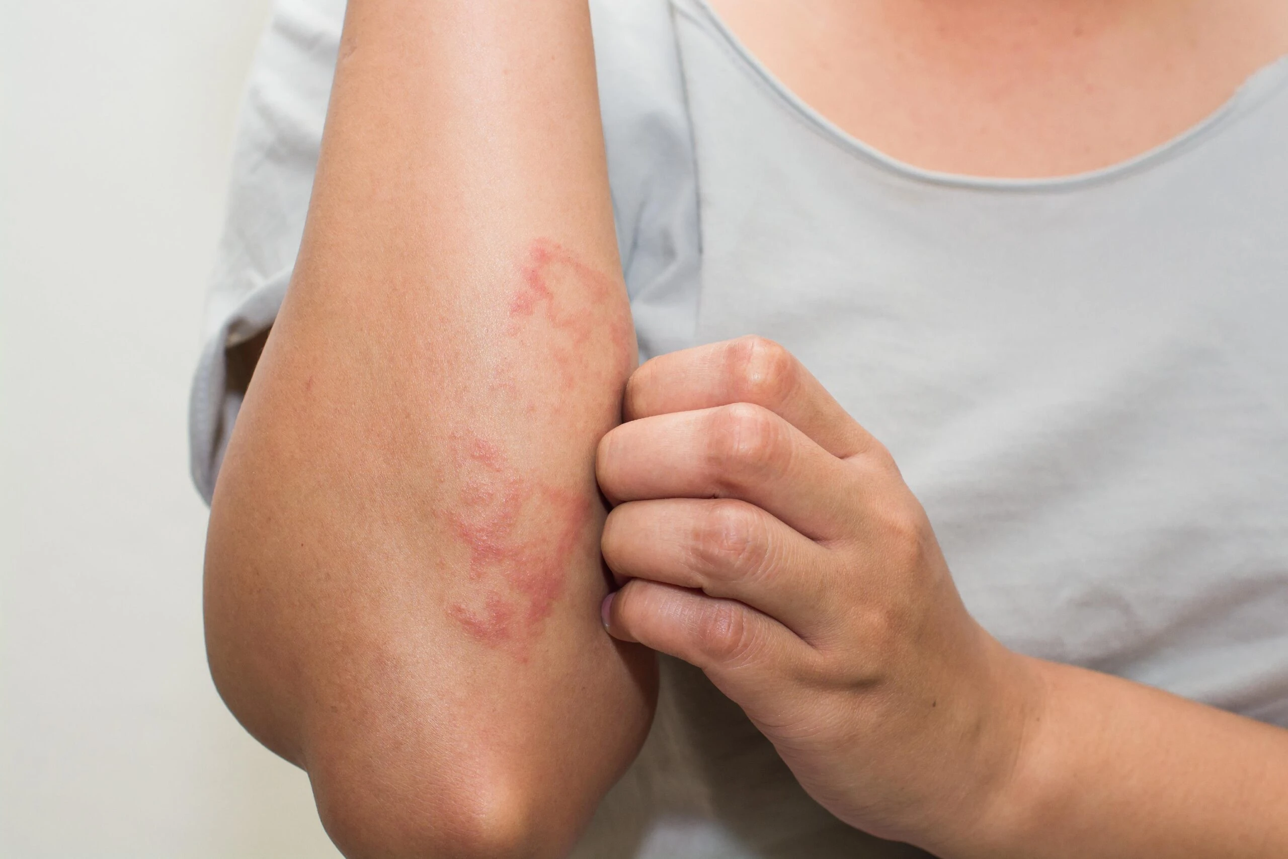 LDM local dynamic micro-ultrasound treatment for eczema