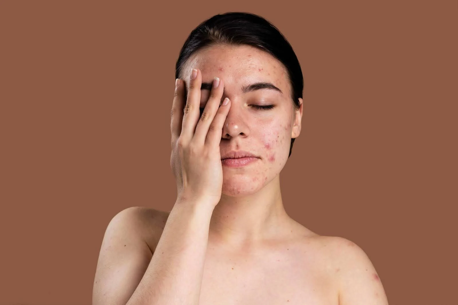 Diet and lifestyle changes for hormonal acne