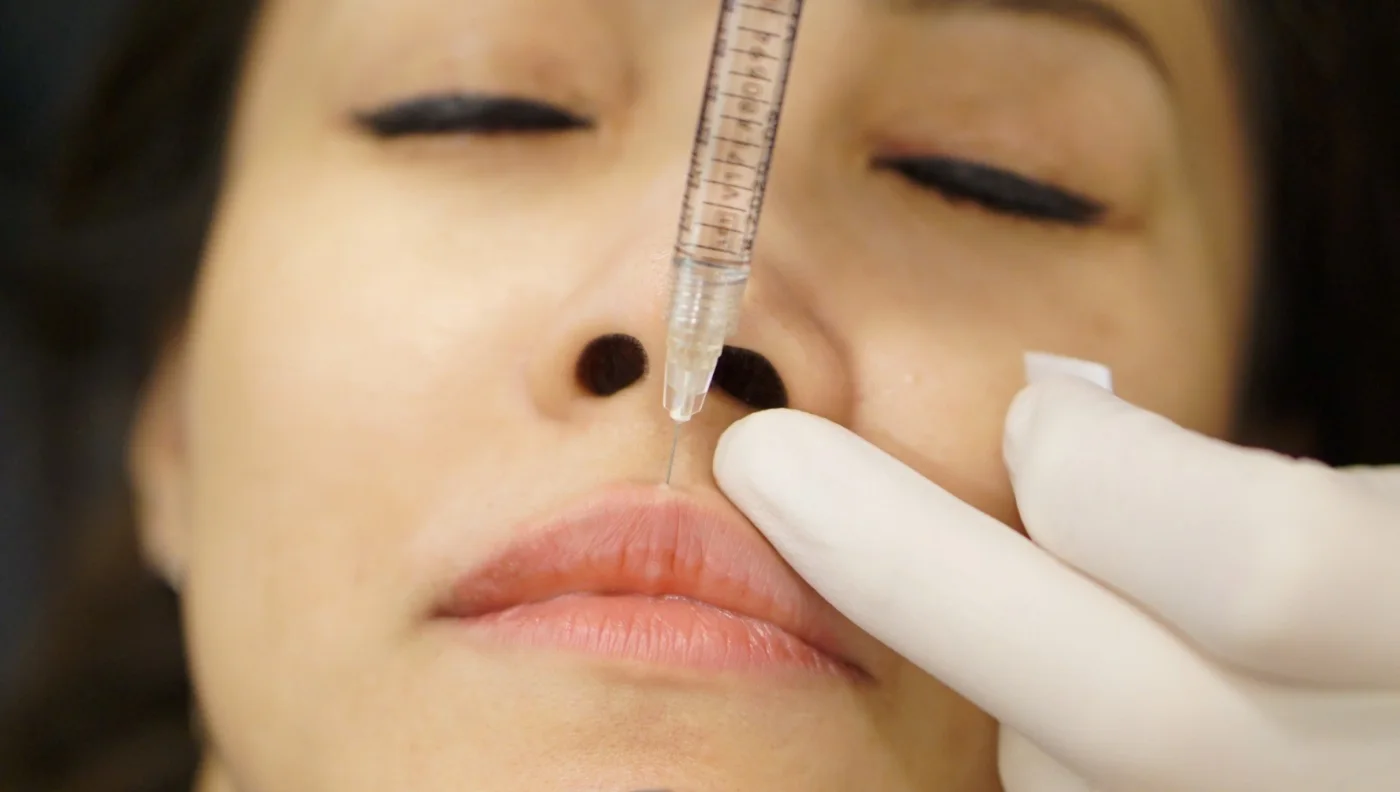 Filler helps: What Are Lip Fillers? Filler helps: What Are Lip Fillers?