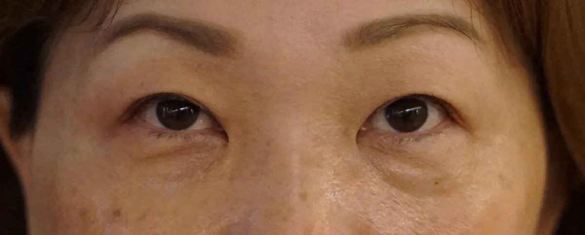 Lower eyelid eye bags from fat protrusion, the type non-surgical eye bag removal treats