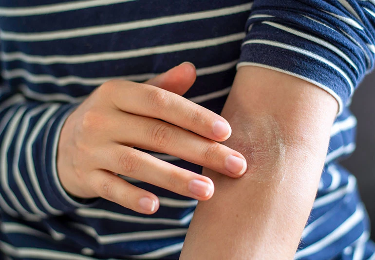 Moisturising cream used to manage eczema