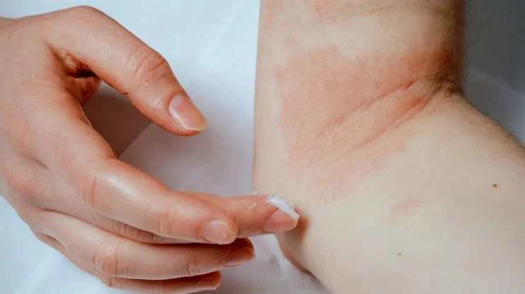 Eczema treatment and management in Singapore