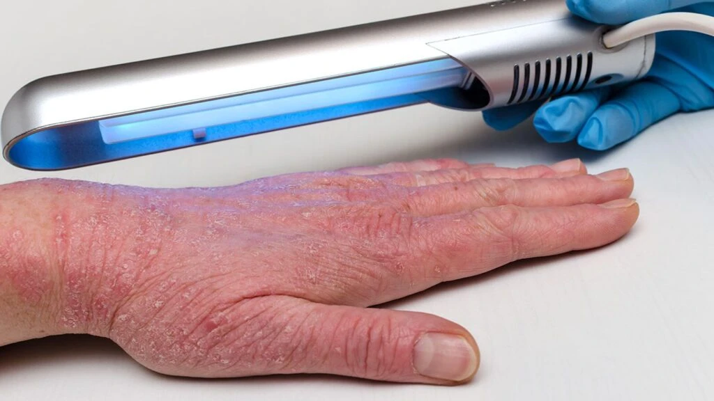 UVB light therapy for eczema