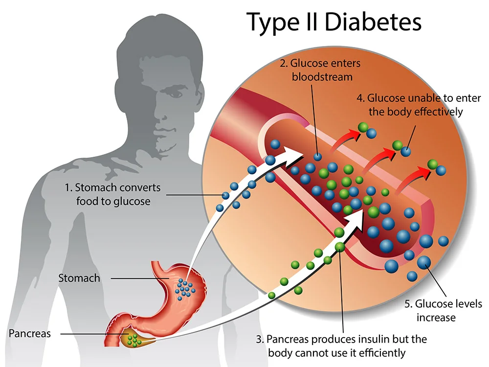 Type diabetes 49a3ee: Metformin and longevity – What is the evidence?