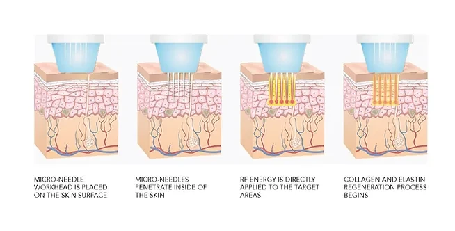 Microneedle fractional radiofrequency for melasma