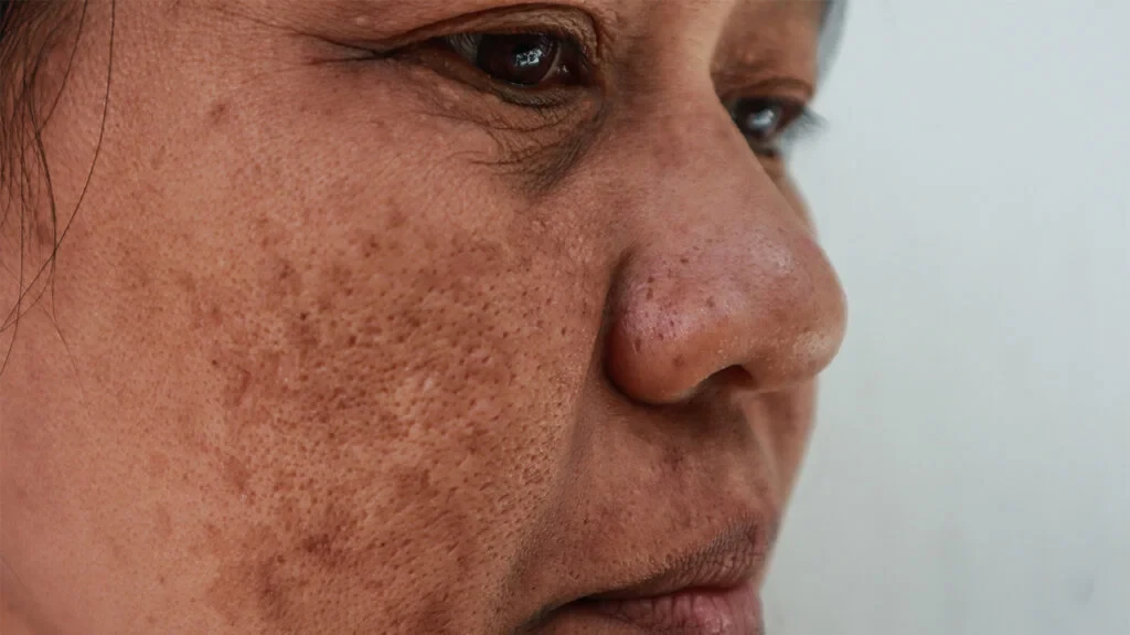 Melasma on the cheeks treated in Singapore